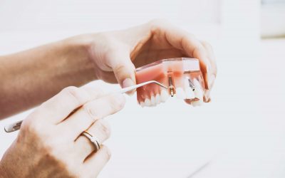 Ventajas y desventajas de los implantes dentales