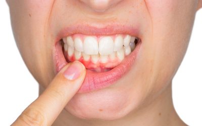 Fases del tratamiento periodontal