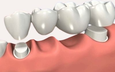 ¿Qué son los puentes y las coronas dentales?
