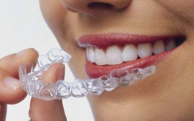 ¿Cuál es el tratamiento de ortodoncia invisible de nuestra clínica dental de Móstoles?
