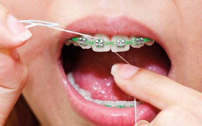 ¿Cómo usar hilo dental con brackets?
