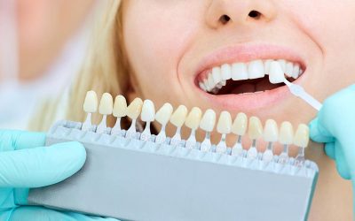 ¿Qué problemas solucionan las carillas dentales?