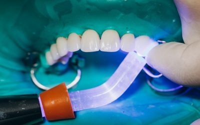 ¿Pueden llevar carillas dentales los pacientes con bruxismo?