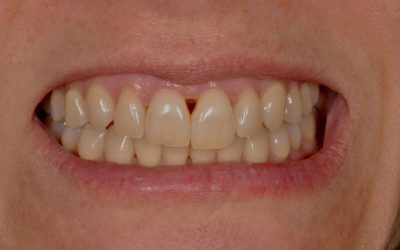 Espacios negros entre los dientes, ¿qué son?