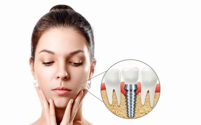 ¿Pueden moverse los implantes dentales?