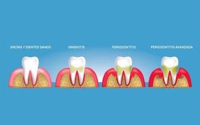 3 diferencias entre gingivitis y periodontitis