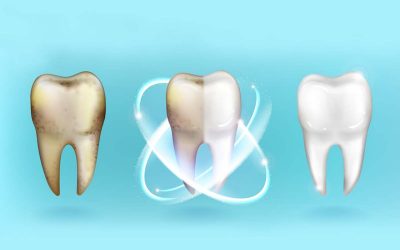 ¿Por qué se produce sensibilidad tras un blanqueamiento dental?