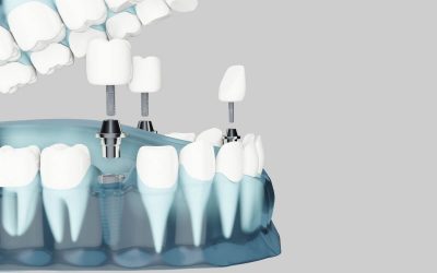 Posibles complicaciones de los implantes dentales