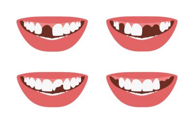 ¿Qué es una agenesia dental?