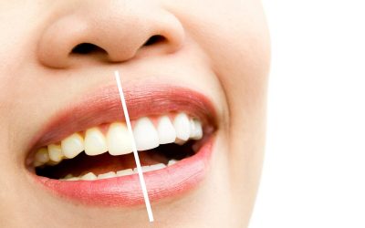 Bulos sobre blanqueamiento dental a los que NO hacer caso