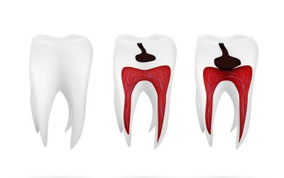 ¿Cuántas endodoncias puede hacerse una persona?