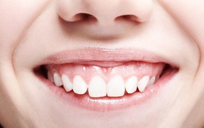 ¿Qué es la sonrisa gingival y cómo podemos tratarla?