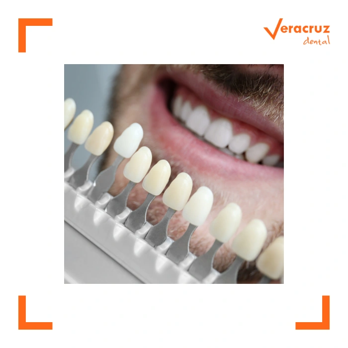 carillas dentales en mostoles veracruz