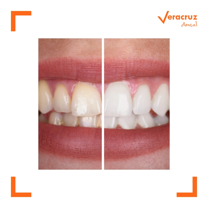 elige nuestro blanqueamiento dental en mostoles